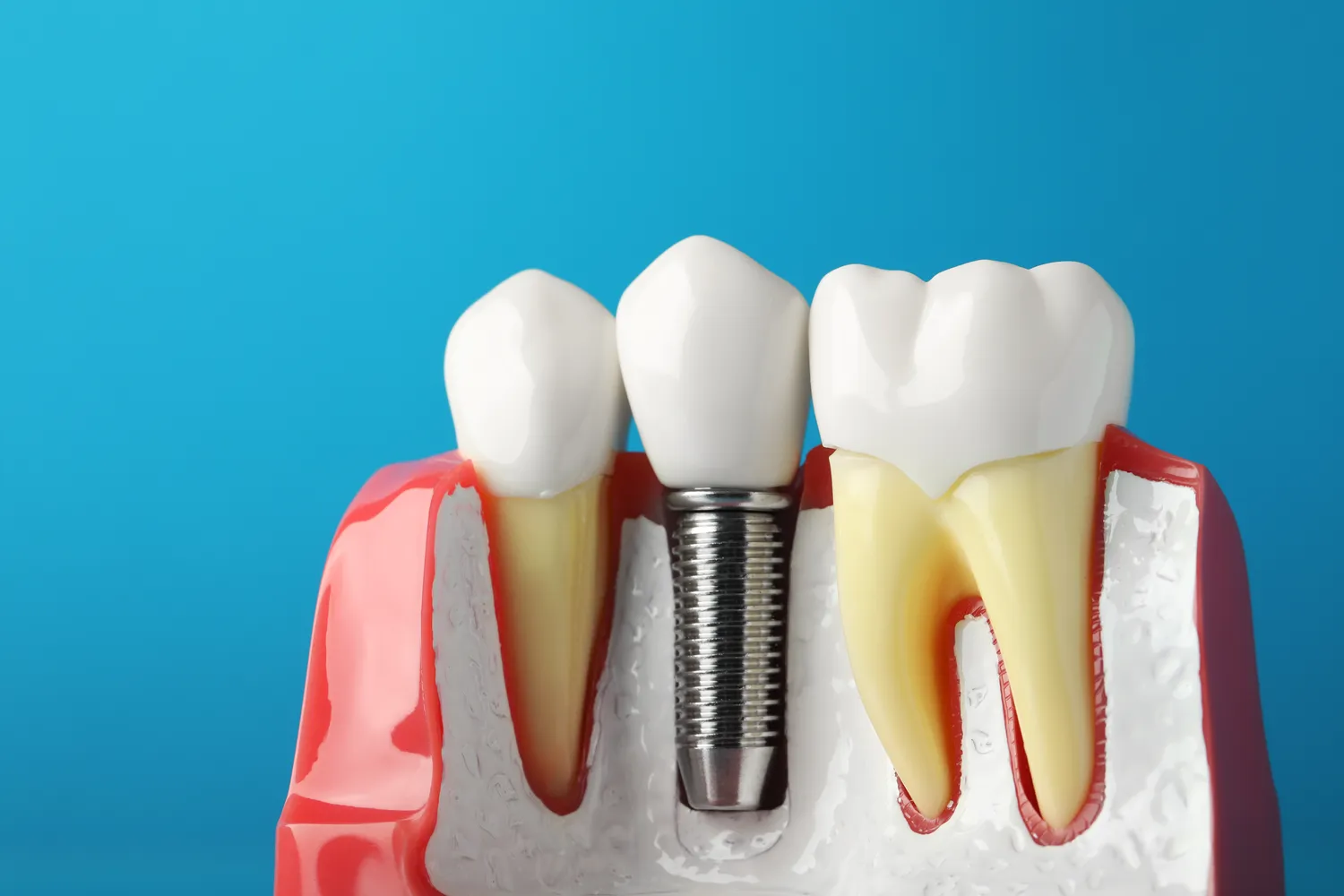Co trzeba wiedzieć o implantach zębowych?