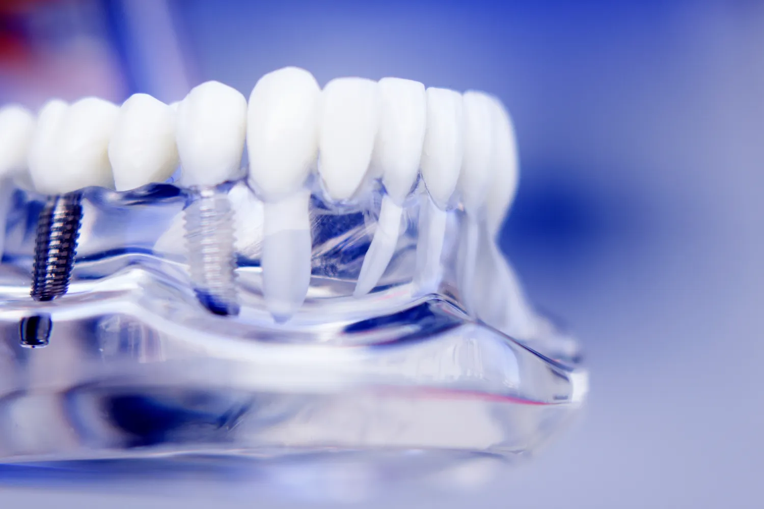 Jakie są rodzaje implantów zębowych?