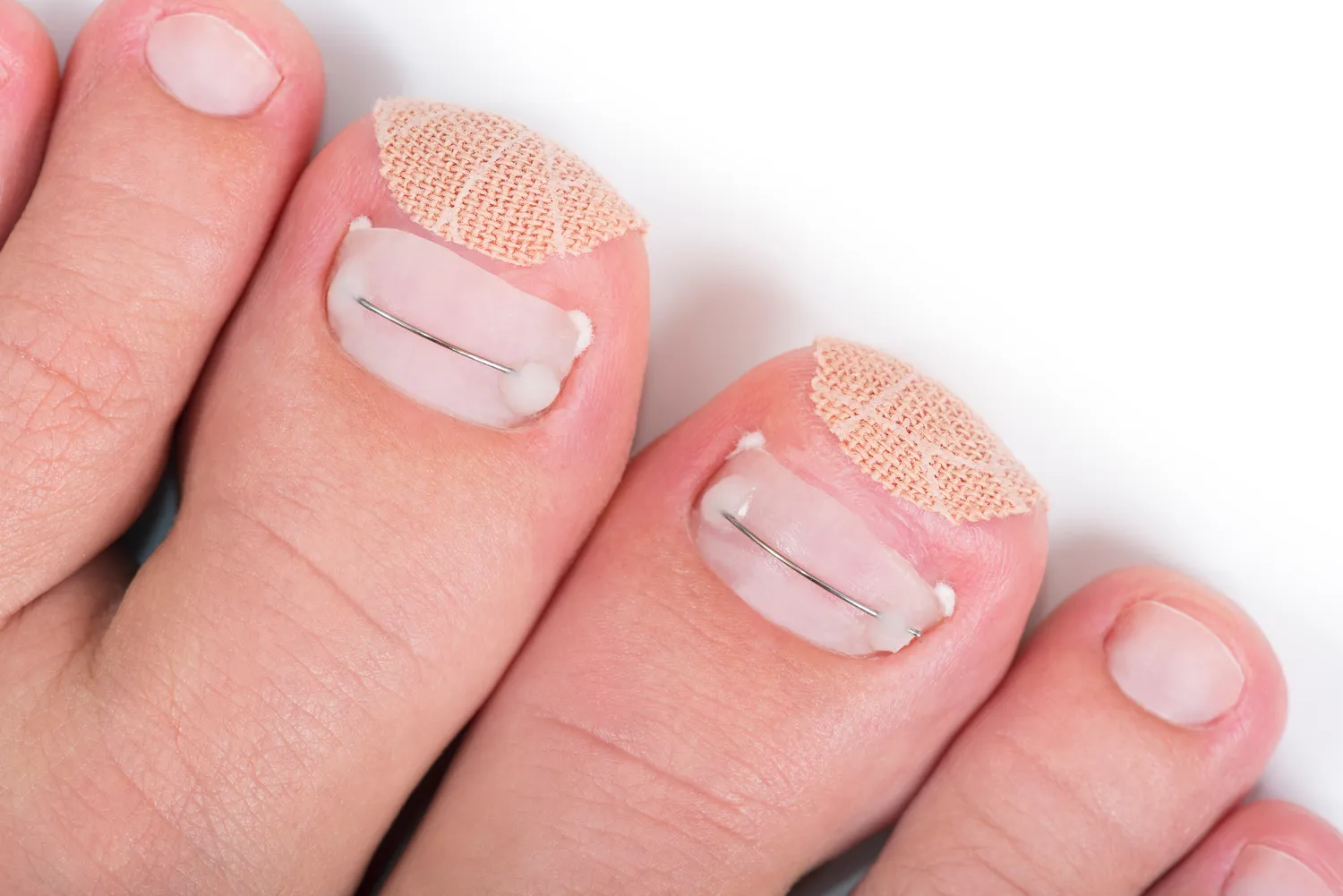 Pedicure leczniczy - co na ten temat wiedzieć trzeba?