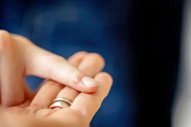 Ile trwa usuwanie kurzajki?