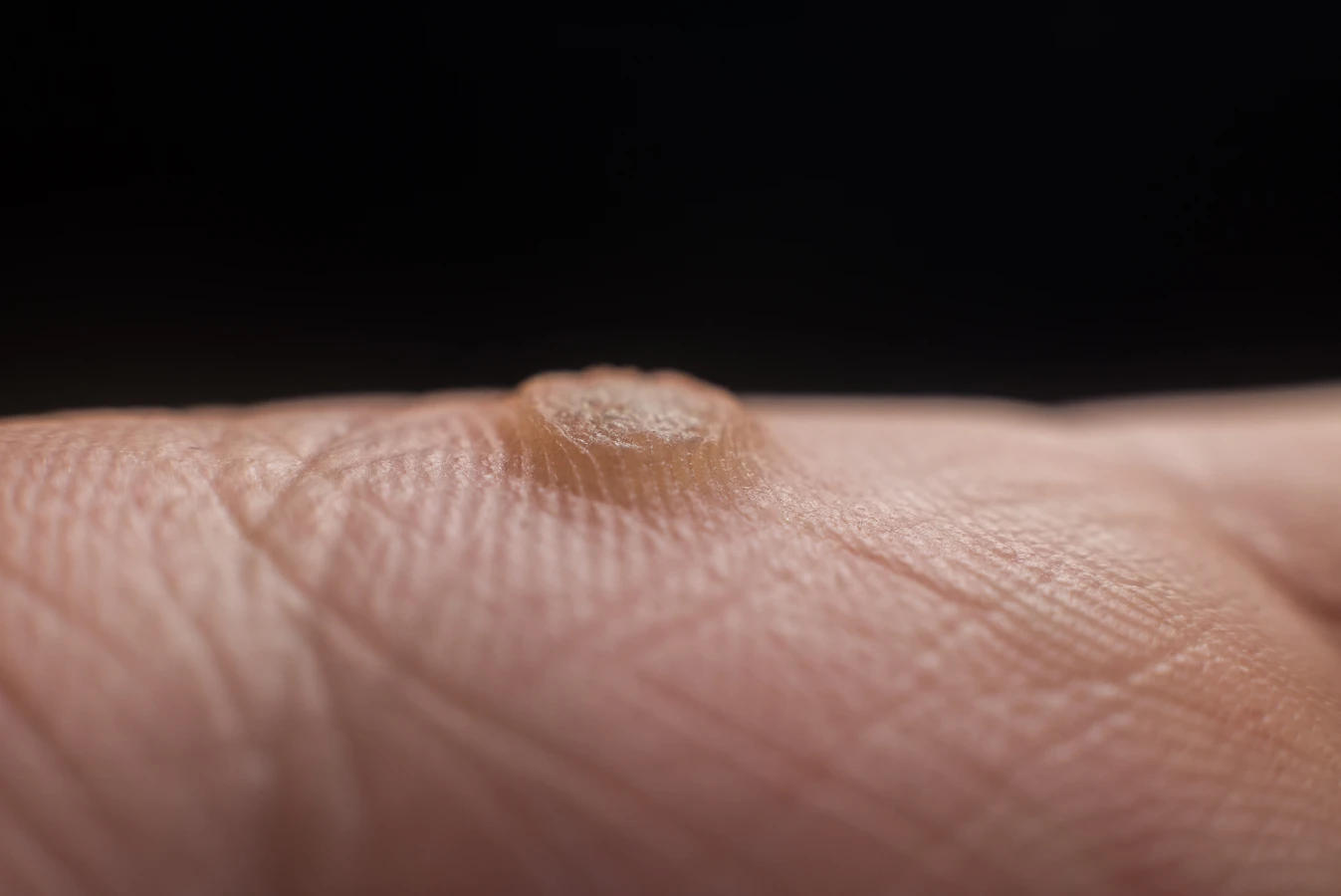 Jak wygląda początek kurzajki?